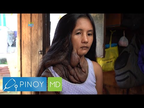 Pinoy MD: Sanhi ng pagkakaroon ng Neurofibromatosis, alamin