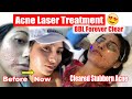 Clearing Acne with Laser Treatment: A Personal Journey and Valuable Insights