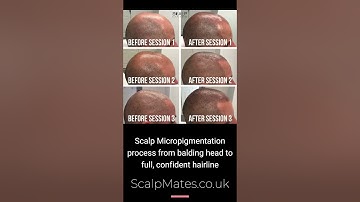 The Non-Invasive Solution for Bald Head & Hair Loss - #SMP Transformation #hairlinetattoo #shorts
