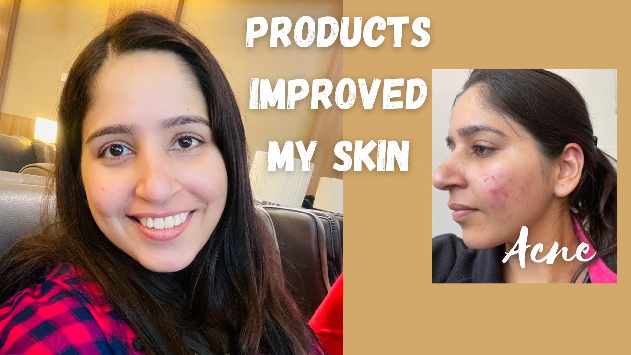 Products that improved my skin with Acne and Pigmentation | Products ...