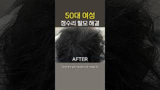 정수리 탈모로 고민이던 50대 여성