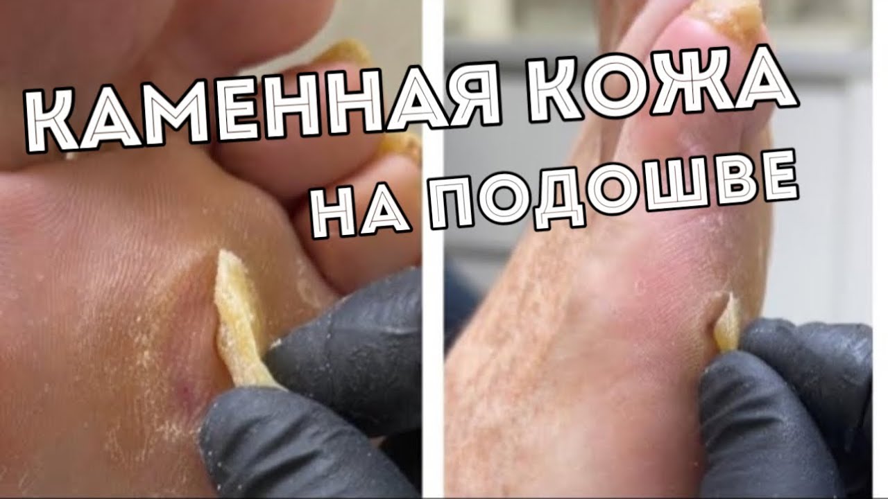 Медицинский педикюр. Удаление стержневых мозолей #подологмосква #мозоли ...
