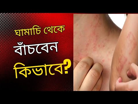 ঘামাচি থেকে বাঁচবেন কিভাবে || How to avoid scratching|| - YouTube
