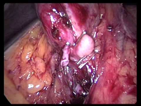 Laparoscopic Cholecystectomy (unedited-49)-Chronic Cholecystitis Much Omental Adhesion