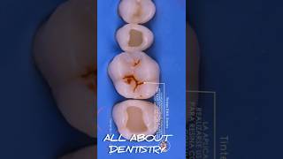 Dental Motivation. Direct Composite Restoration Teeth.