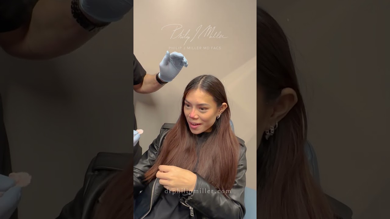 Subtle But Effective Liquid Rhinoplasty Results! Non-Surgical Solution To Refresh Your Look!