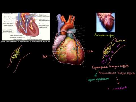 ИБС и сердечные приступы