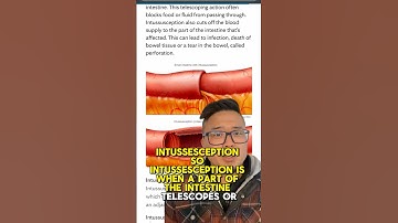 Some facts about intussusception. #health #wellness #interesting #fitness #nutrition