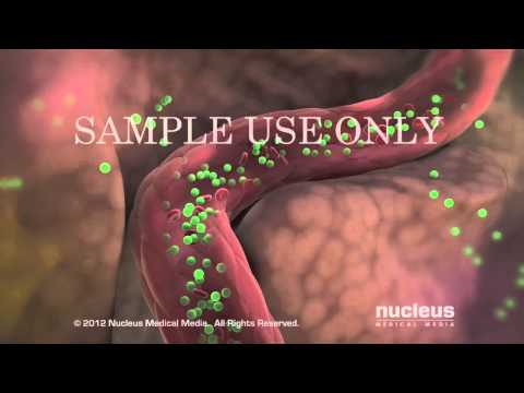 Video: ¿El SOP causa revestimiento uterino delgado?
