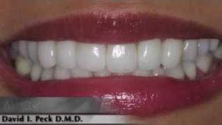 Porcelain Dental Veneers for Boston-area Patients  Creating New Smile