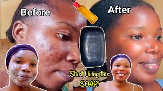 Black Soap For Clearing Pimples  Acne Darkspots U0026 Hyperpigmentation Cure All Your Skin Diseases