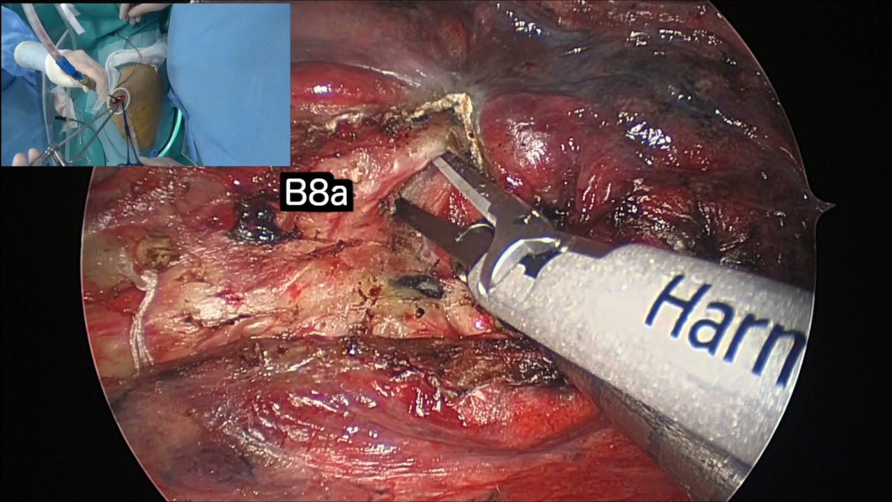 【#32】UP VATS segmentectomy: lt  S8b (including S9b wedge), 単孔式胸腔鏡下S8b区域切除術