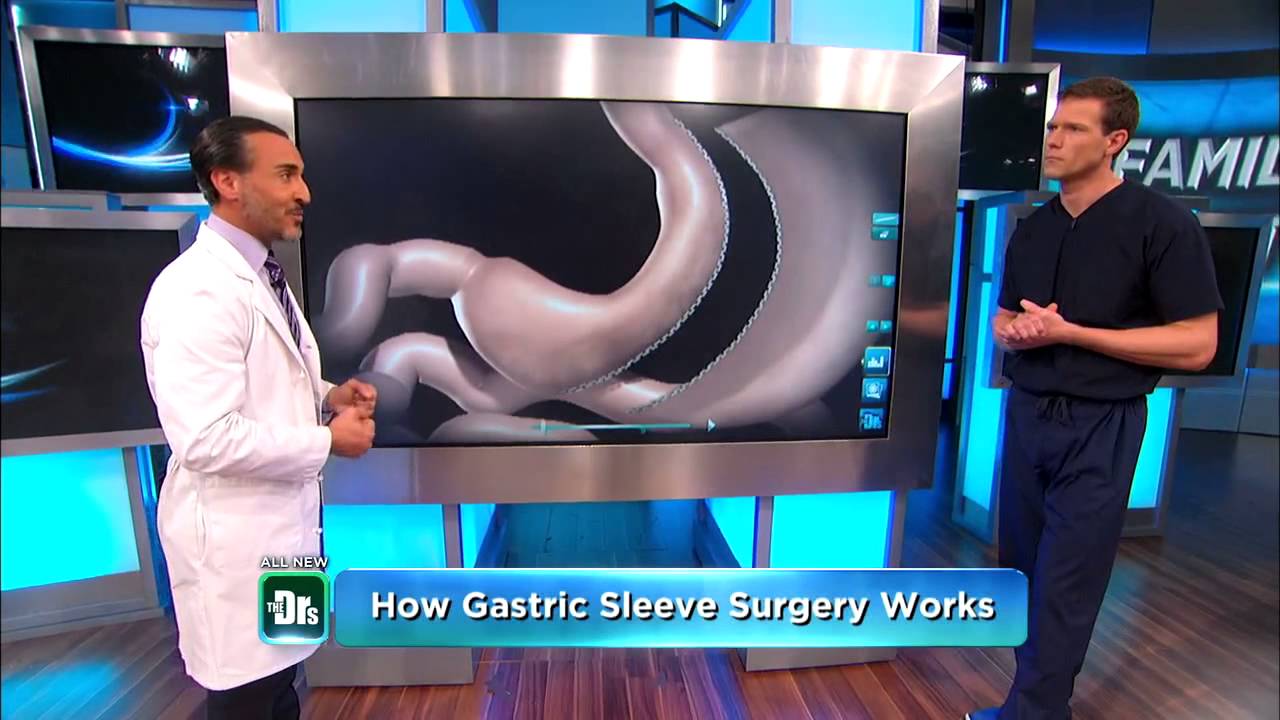 Doctors TV Weight Loss, Sleeve Gastrectomy by Dr. Feiz Part 3 YouTube