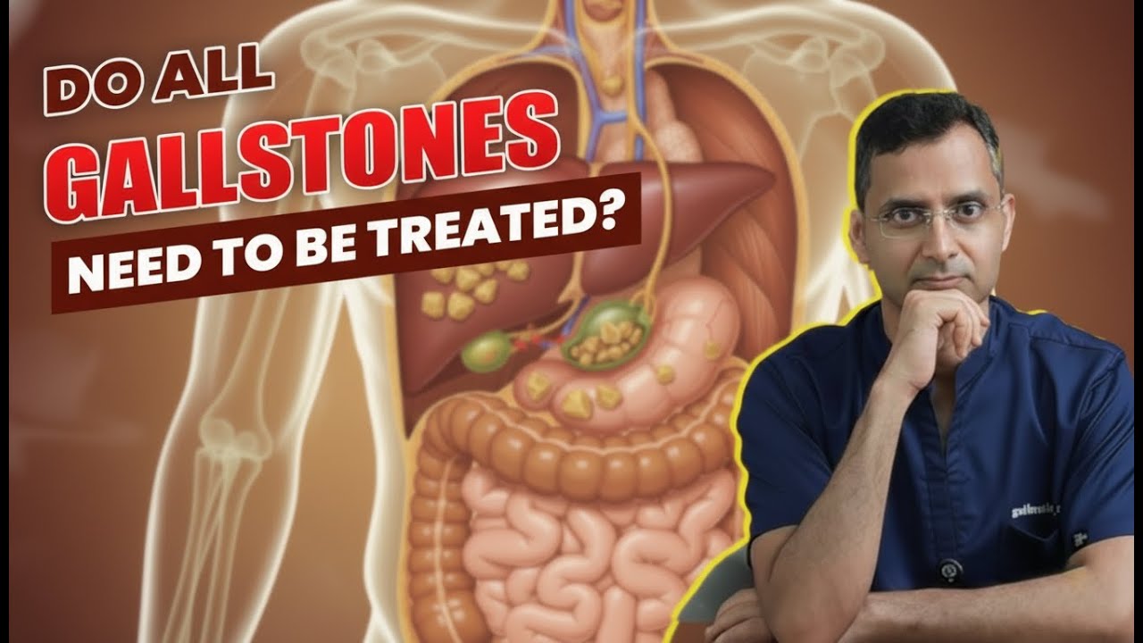 Все ли камни в желчном пузыре нужно лечить? | Реальное руководство по принятию решений