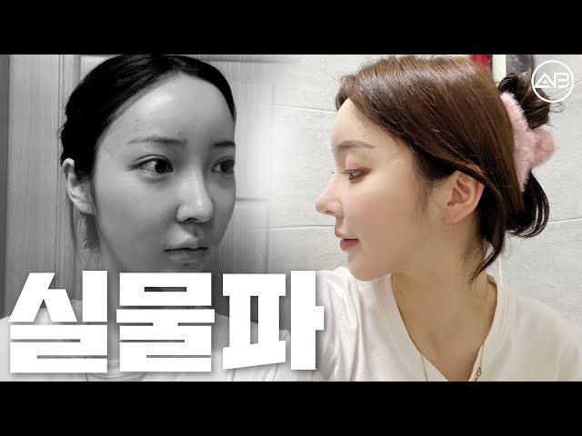 실물이 더 예쁜편입니다 | 3년차 후기 | 에이비성형외과