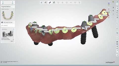 Workflow von Connect Case Center Inbox zu 3Shape: Implantatfall "All-on-4" PLY Format