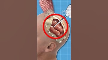 NẾU PHẪU THUẬT NÃO NHƯNG VẪN TỈNH TÁO | 😨 (Bạn Biết Không) #facts #amzingfacts #thaukinhtrithuc