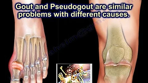 Gout , Pseudogout  & Joint Pain - Everything You Need To Know - Dr. Nabil Ebraheim