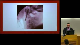 "Surgical Management of Craniocervical Junction Pathology" - Jared Fridley, MD