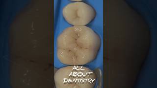 Dental motivation. Direct composite restoration teeth. Composite modeling anatomy teeth. #dentistry