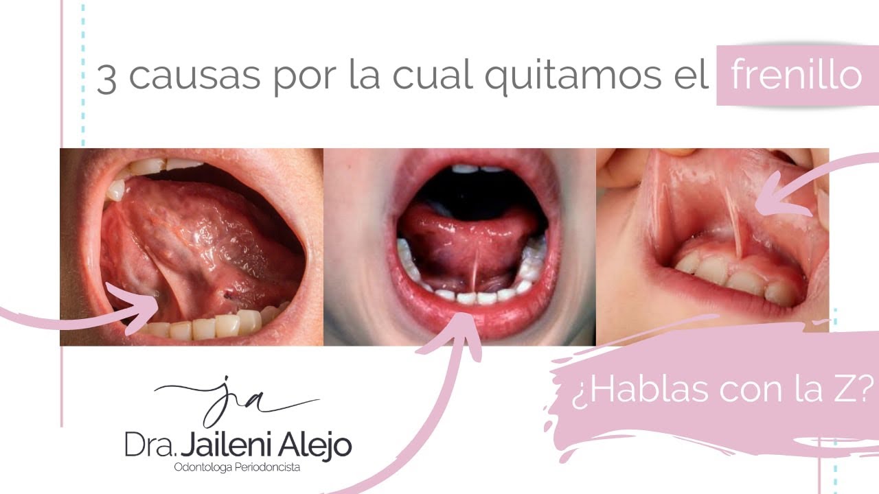 3 CAUSAS POR LA CUAL QUITAMOS EL FRENILLO. YouTube 3 CAUSAS POR LA CUAL QUITAMOS EL FRENILLO. YouTube