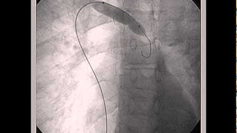 Azygos Vein Balloon Angioplasty / Angioplastía con Balón de Vena Ácigos