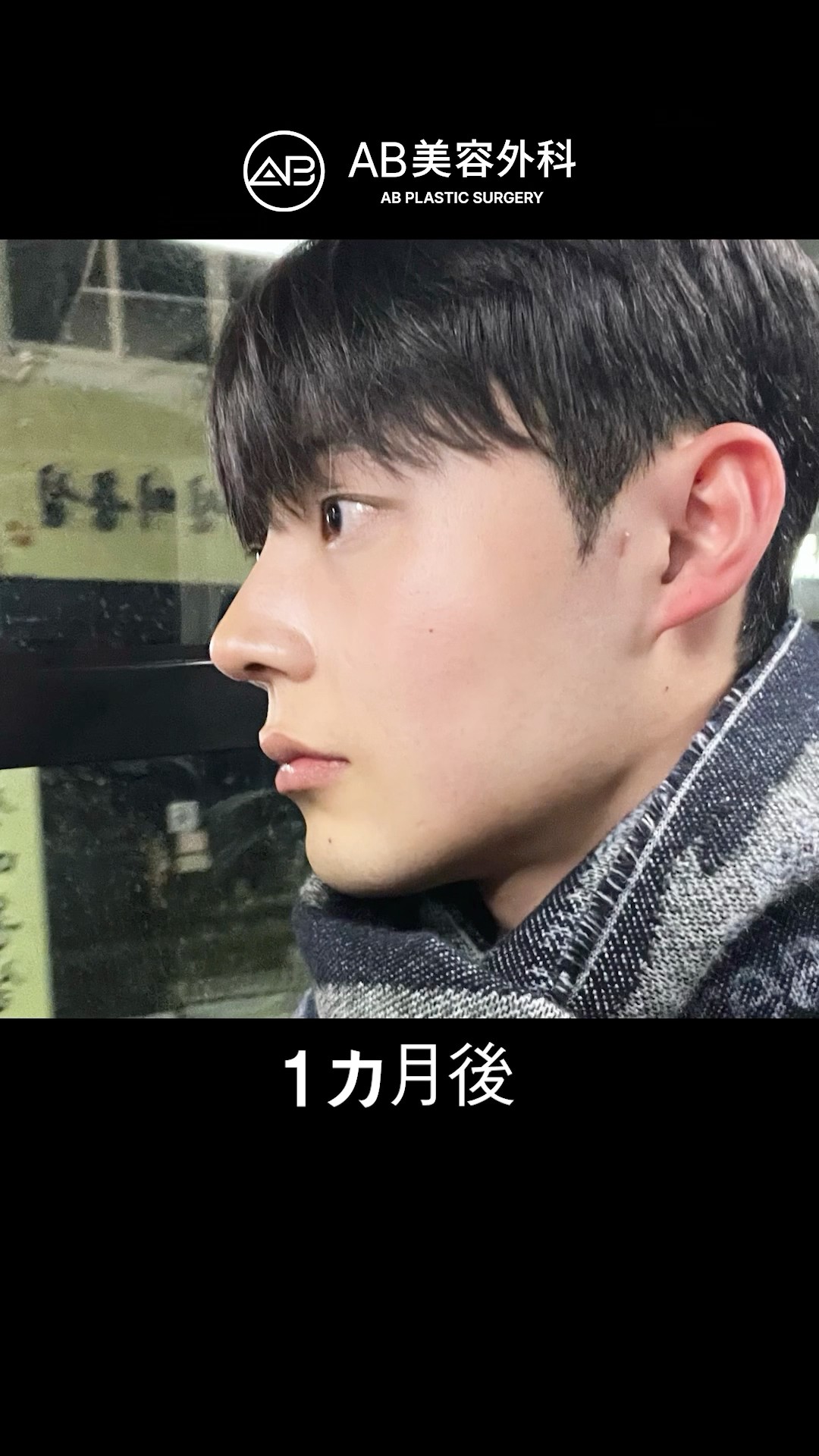 鼻整形後、さらにイケメンに！ | AB美容整形