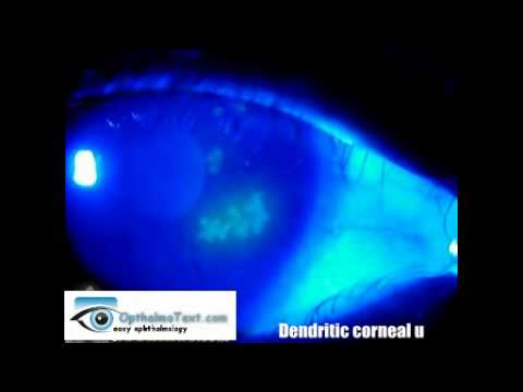 Dendritic corneal ulcer - YouTube