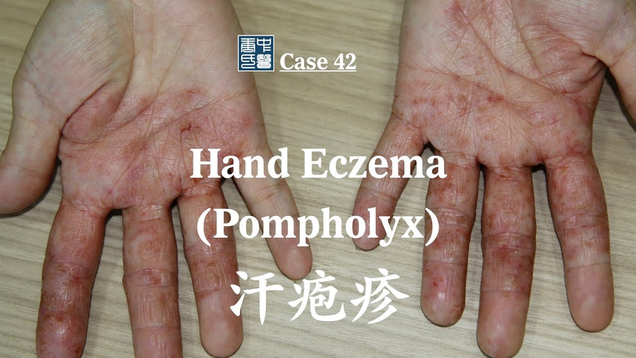 Pomplex hand eczema, pompholyx 手湿疹 汗疱疹 - YouTube