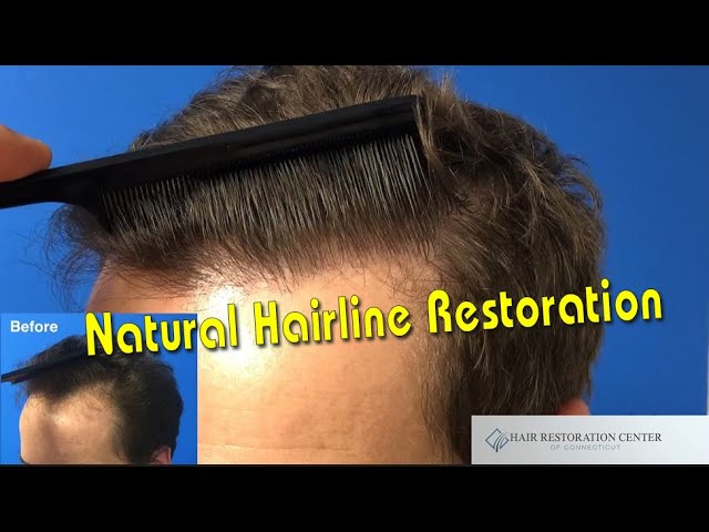 Hair Transplant Results Video before And After