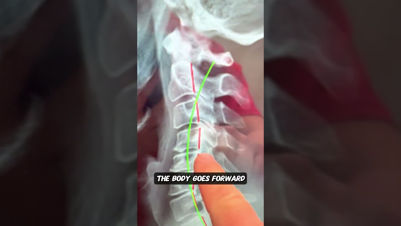 😬 Ouch! Seeing the impact of whiplash on an x-ray is a stark reminder of the hidden damage