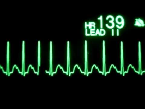 Sinüs Taşikardi ( Eğitim Videosu )