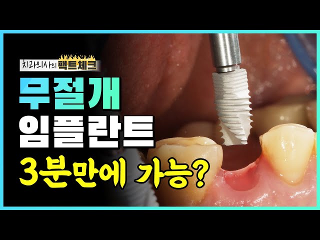 무절개 임플란트 3분만에 가능하다고❓ (수술시간 과정 공개)