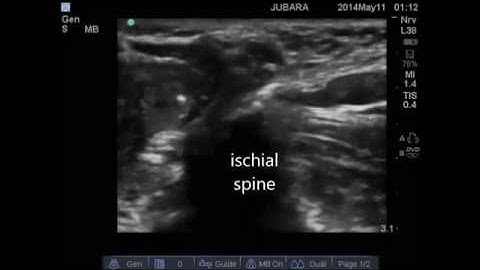 ultrasound guided pudendal nerve block