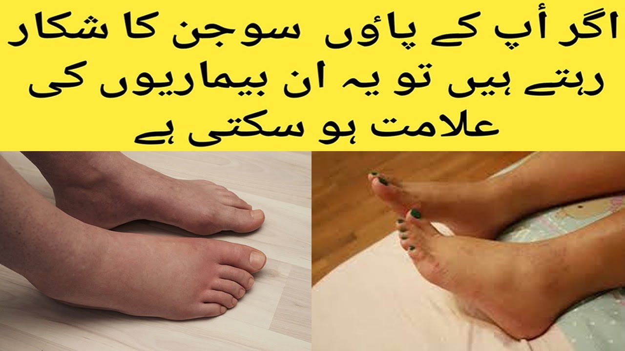 How to reduce swollen feet