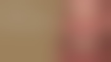 Immediate Implants in Upper and Lower Jaw