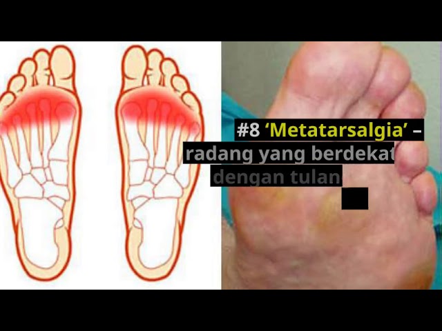 Sakit Tapak Kaki Penyebab Rawatan Dan Cara Menghilangkan Rasa Sakit