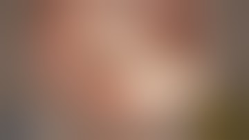 Total Ossicular Chain Reconstruction Malleus Relocation and Silastic Banding (Malleus-to-footplate)