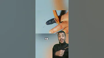 ماذا يحدث حين تصيب ضربة صقيع الاطراف Shorts 