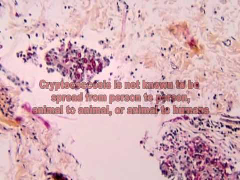 Cryptococcus Fungi: The Cause of Cryptococcosis