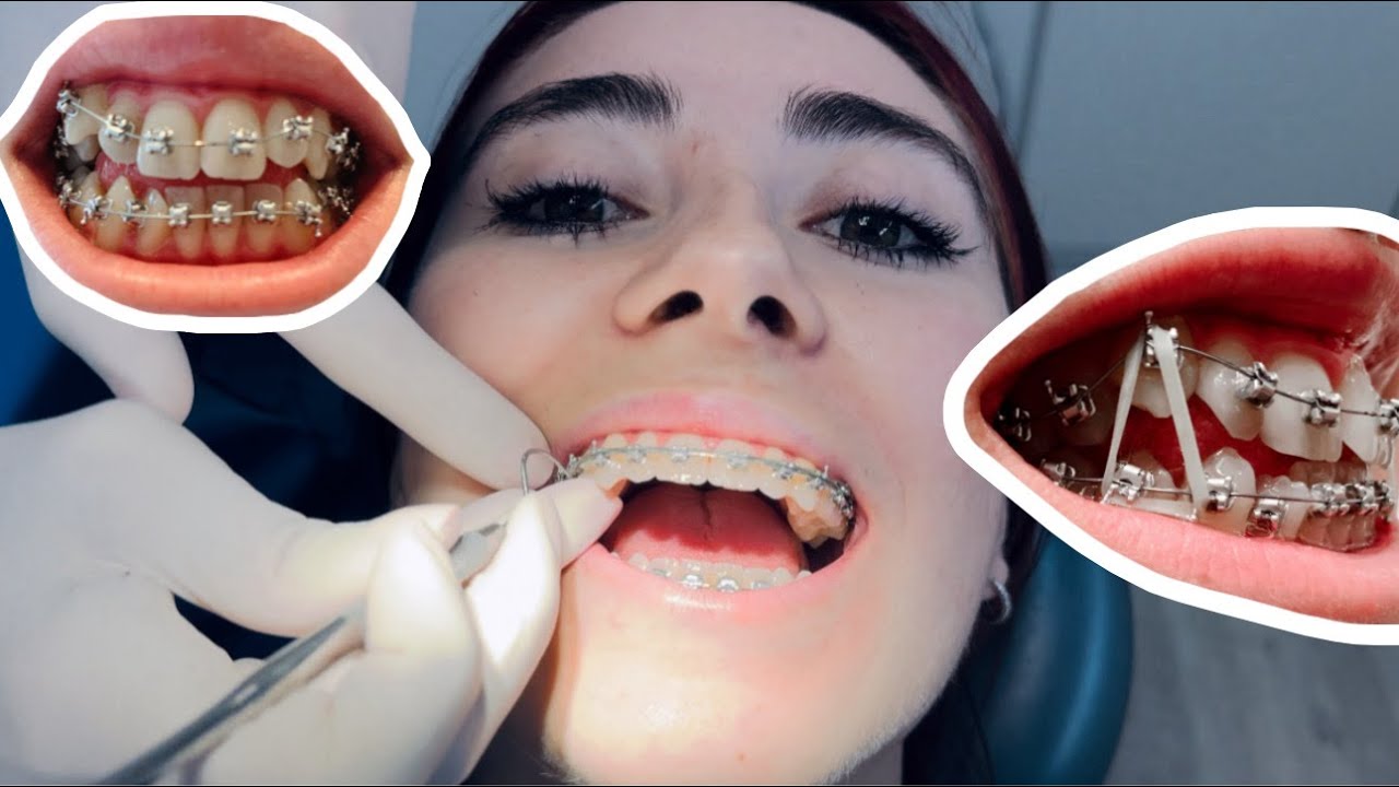 Full BRACES appointment Update YouTube