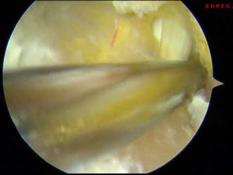 Ligamentoplastie cheville (type anatomique) - 3/7