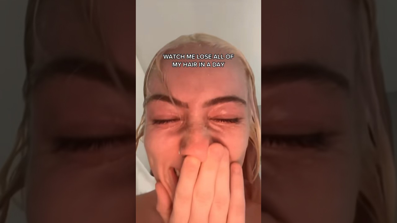 Ver The Original Video of My Hair Falling Out… (part 1) #hairfail #gonewrong #hair #bleaching en YouTube Ver The Original Video of My Hair Falling Out… (part 1) #hairfail #gonewrong #hair #bleaching en YouTube