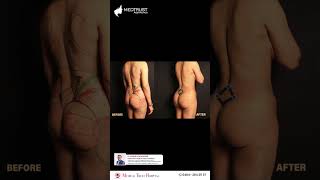 What to expect after a butt augmentation procedure | Explained by Dr. Ananand