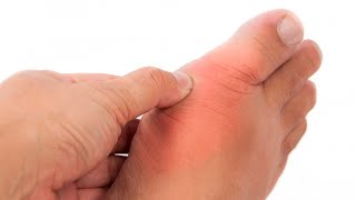 ✅🔴5 NATURAL REMEDIES FOR GOUT screenshot 3