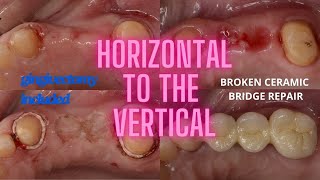 HORIZOTNAL TO THE VERTICAL broken bridge with gingivoplasty