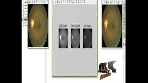 Final Year Projects 2015 | DETECTION OF EXUDATES IN COLOR FUNDUS IMAGE