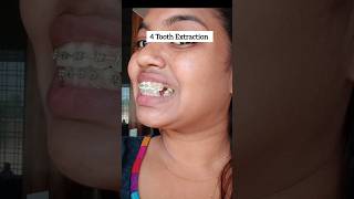 Braces Journey Transformation