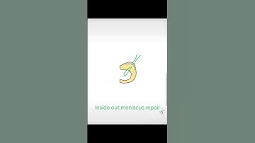 Inside out #meniscus repair ! #orthopedics #medtwitter #knee #kneeinjury #kneesurgey