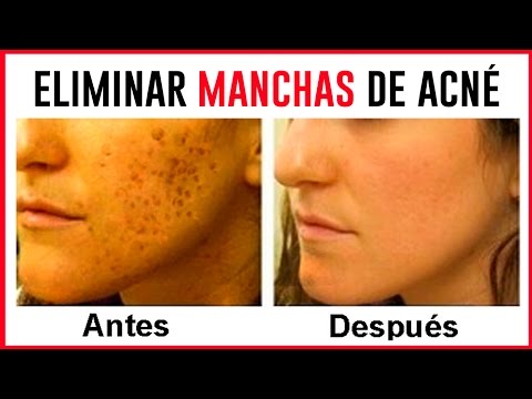 La mancha oscuro en la piel del bronceado